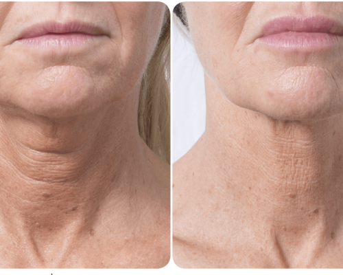 szyja_foto_BROCHURE_BAP_NECK_TECHNIQUE_HR_0